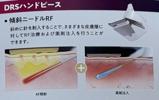斜めに入れる細い針で高周波照射と薬剤注入を行う仕組みを示した配布資料の図