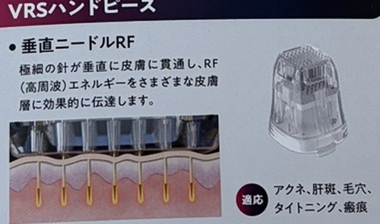 複数の細い針を皮膚に垂直に入れる高周波治療の配布資料の図